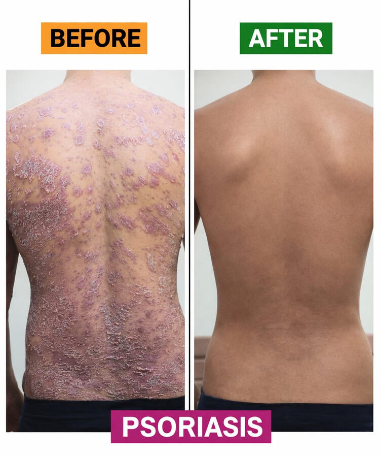 We have permanent solution for psoriasis.